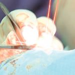 انسانی سر کی پیوند کاری، سرجن نے مریض تبدیل کرلیا