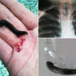 چین ،کھانسی کی شکایت پر گلے میں جونک کی موجودگی کا انکشاف