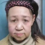 انوکھی بیماری نے 15 سالہ چینی بچی کو بوڑھی خاتون بنا دیا