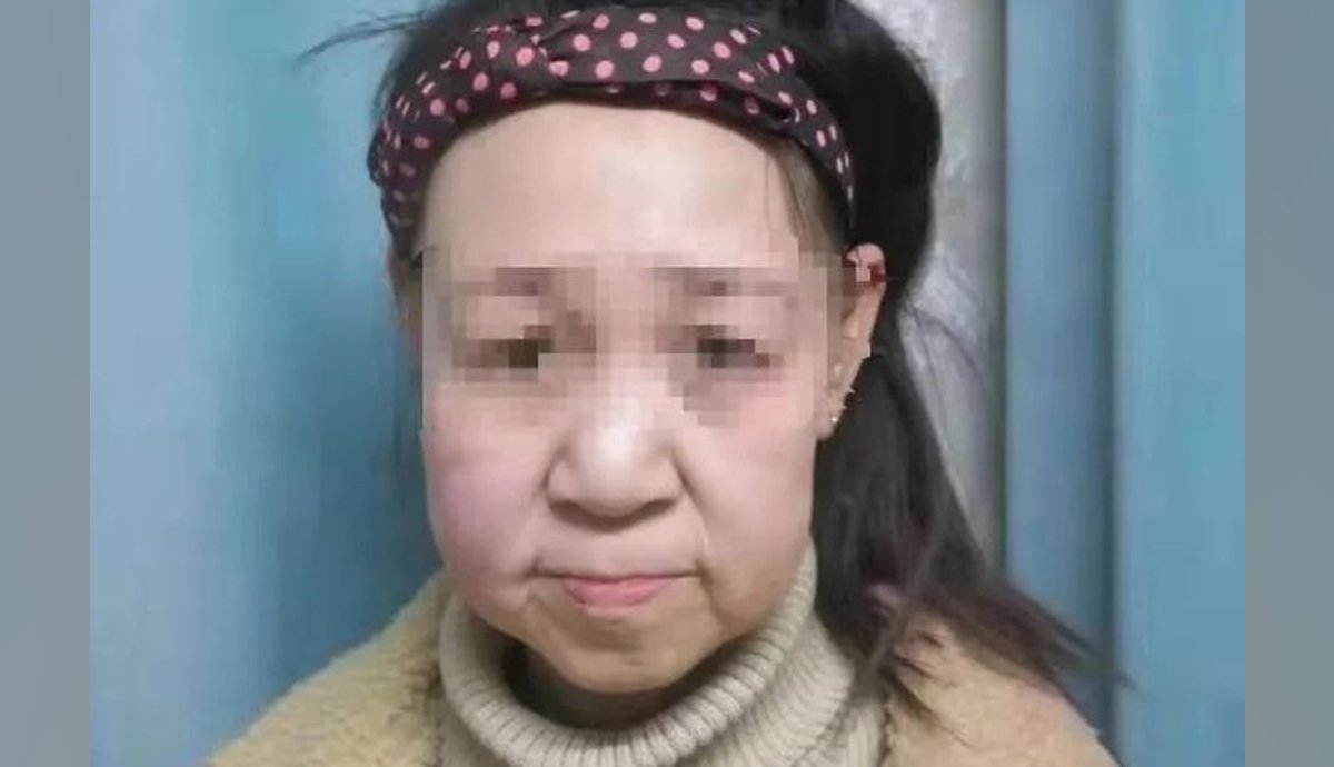 انوکھی بیماری نے 15 سالہ چینی بچی کو بوڑھی خاتون بنا دیا