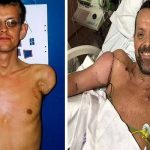 دنیا کا پہلا بازوؤں کا ٹرانسپلانٹ آپریشن، معذور شخص کو 23 سال بعد ہاتھ مل گئے