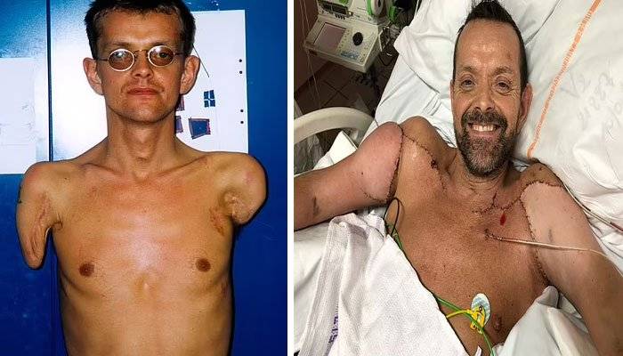 دنیا کا پہلا بازوؤں کا ٹرانسپلانٹ آپریشن، معذور شخص کو 23 سال بعد ہاتھ مل گئے