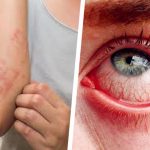 سرخ آنکھیں اور جلد کی خارش بھی اومی کرون کی علامات قرار