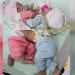 دھڑ سے جڑی 2نومولود بہنوں کی کامیاب سرجری