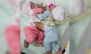 دھڑ سے جڑی 2نومولود بہنوں کی کامیاب سرجری