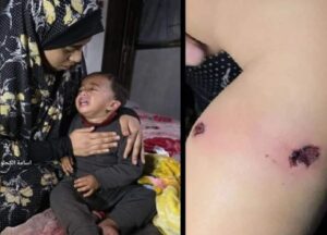 اسرائیلی فوج نے فلسطینی 18 ماہ کے بچے کو سگریٹ سے داغ دیا
